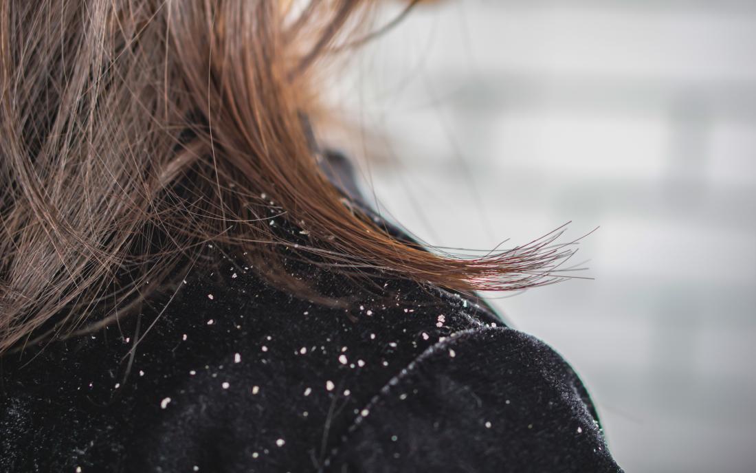7-Day Anti-Dandruff Plan: Clear Flakes and Calm Your Scalp Without Harsh Chemicals